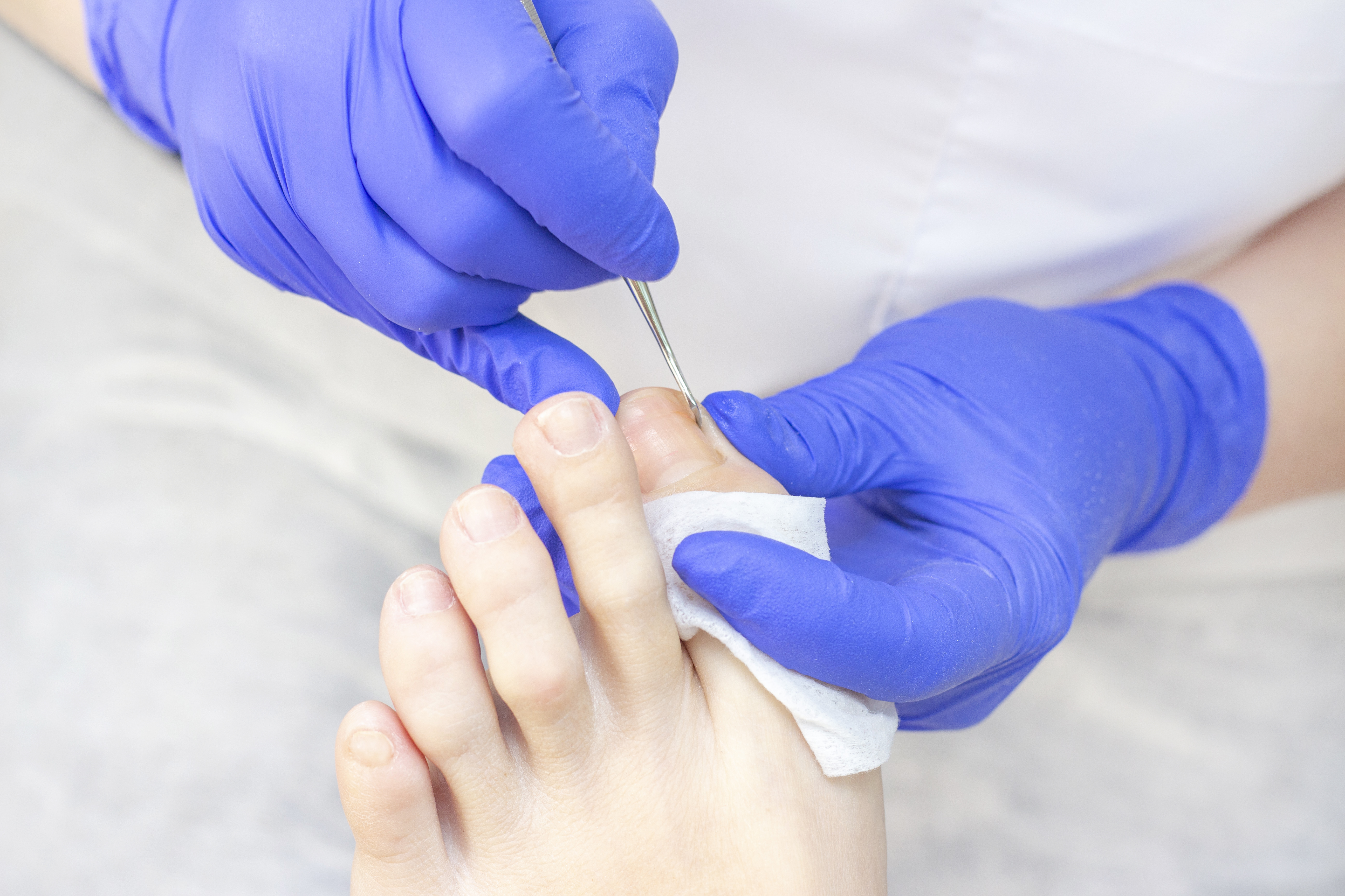 Tırnak batması, tırnak mantarı, kalınlaşmış veya şekli bozulmuş tırnaklar, travmaya bağlı tırnak kayıpları ve tırnak yüzeyindeki deformasyonlar en sık görülen podolojik problemlerdir. Bu durumlar zamanla ağrıya, enfeksiyona ve yaşam kalitesinde düşüşe neden olabilir. Ayak Sağlığı Merkezimizde tırnak problemleriniz detaylıca değerlendirilir; tedavi planı oluşturularak podolojik işlemler ve düzenli takip hizmetleriyle tırnağın sağlıklı yapısına kavuşması hedeflenir. Sorunun kaynağı belirlenerek, kişiye özel ve güvenli yöntemlerle en uygun çözüm planı oluşturulur.